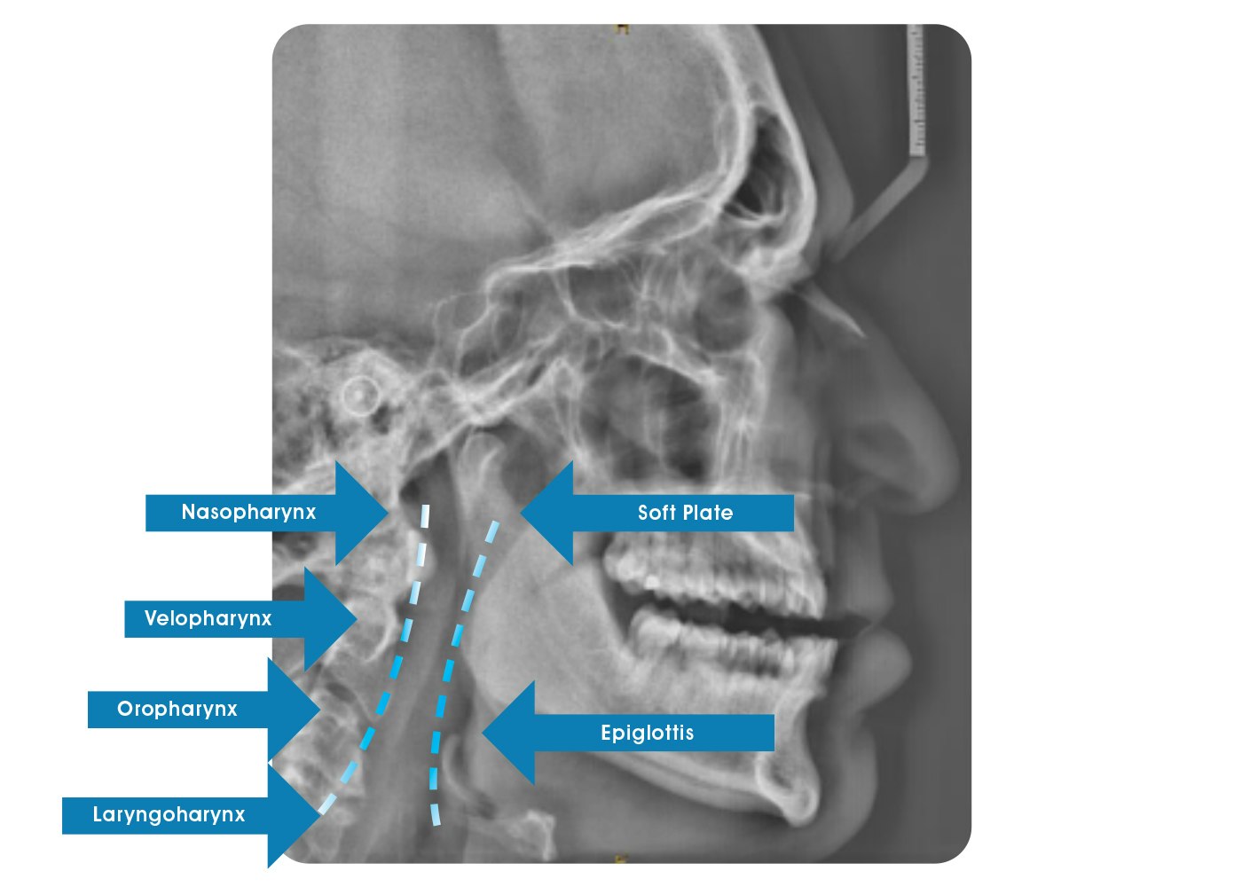 RIPsnore Xray 2