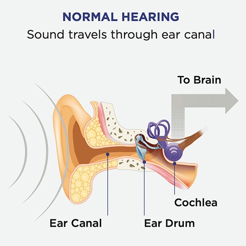 Normal Hearing Graph